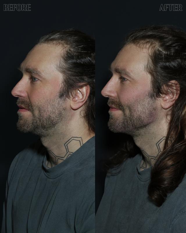 Unretouched before and after result, the drBand Clinic