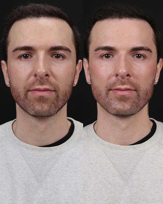 Unretouched before and after result, the drBand Clinic