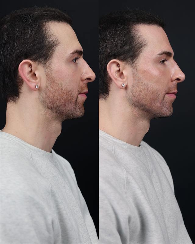 Unretouched before and after result, the drBand Clinic