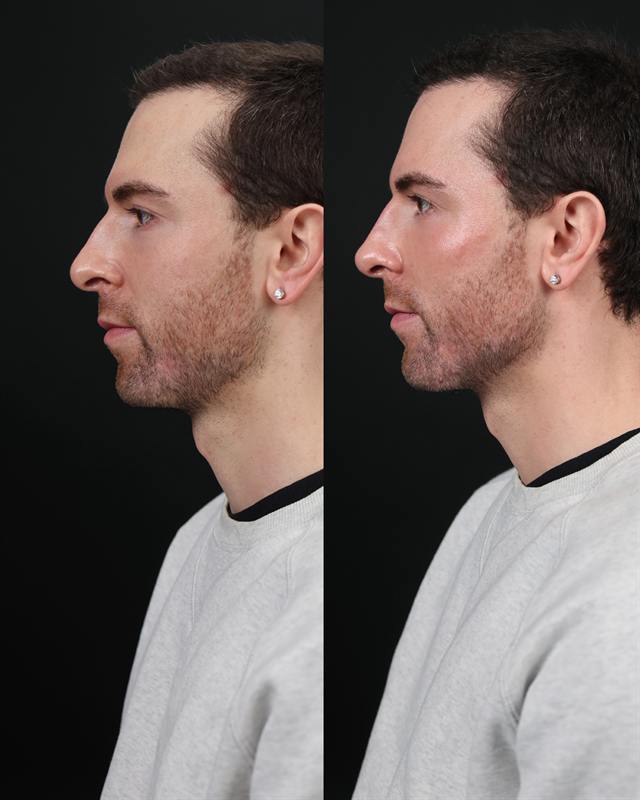 Unretouched before and after result, the drBand Clinic