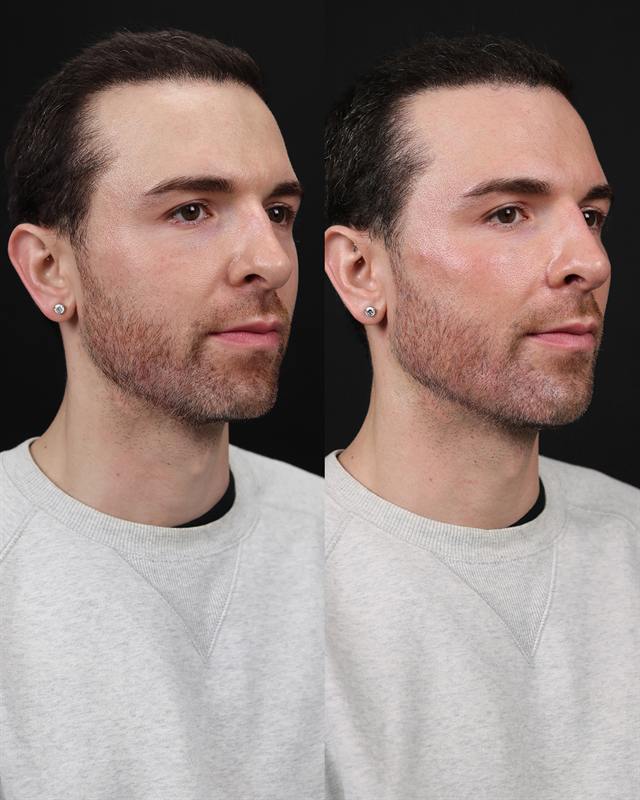 Unretouched before and after result, the drBand Clinic