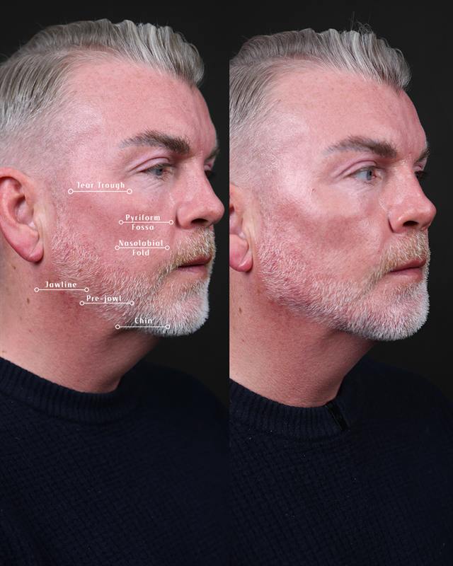 Unretouched before and after result, the drBand Clinic
