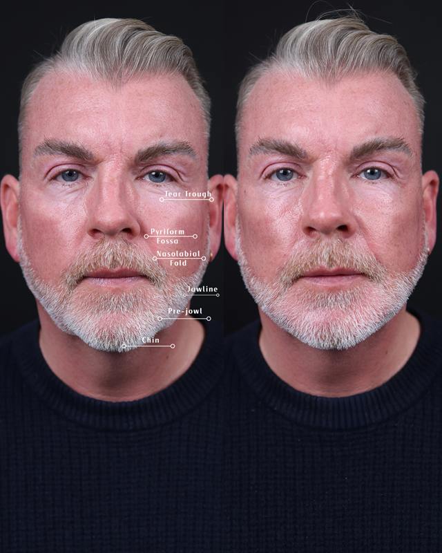 Unretouched before and after result, the drBand Clinic