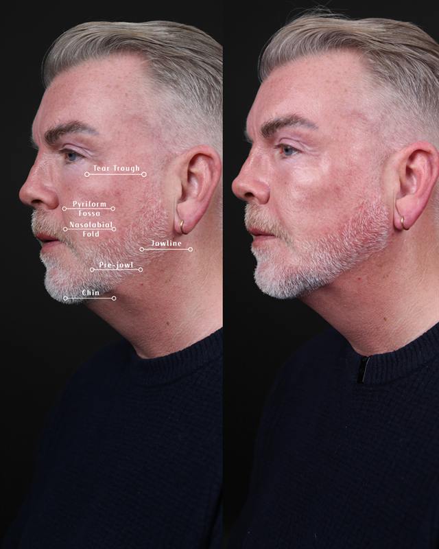 Unretouched before and after result, the drBand Clinic
