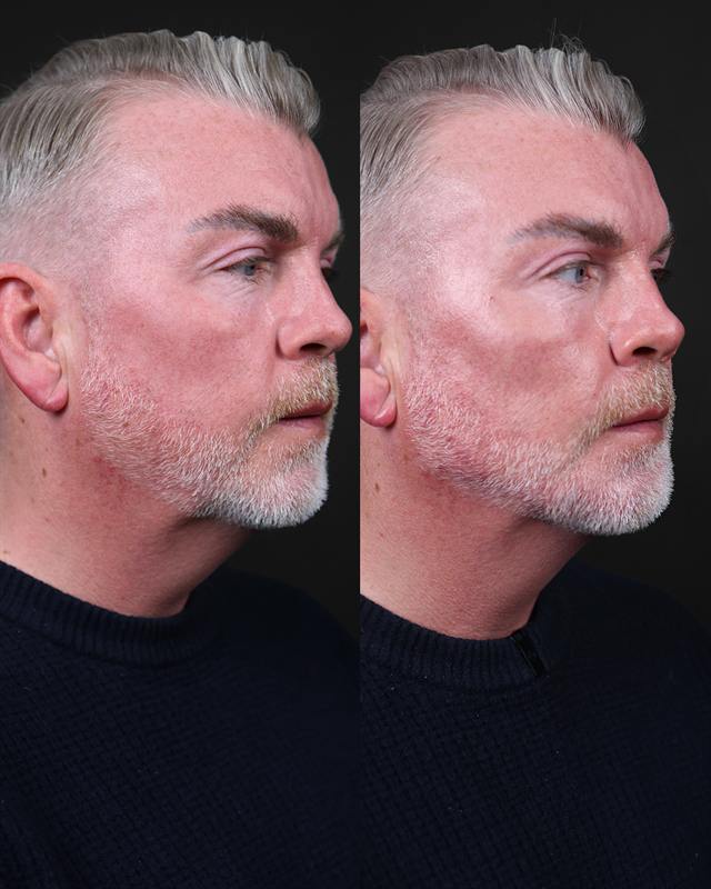 Unretouched before and after result, the drBand Clinic