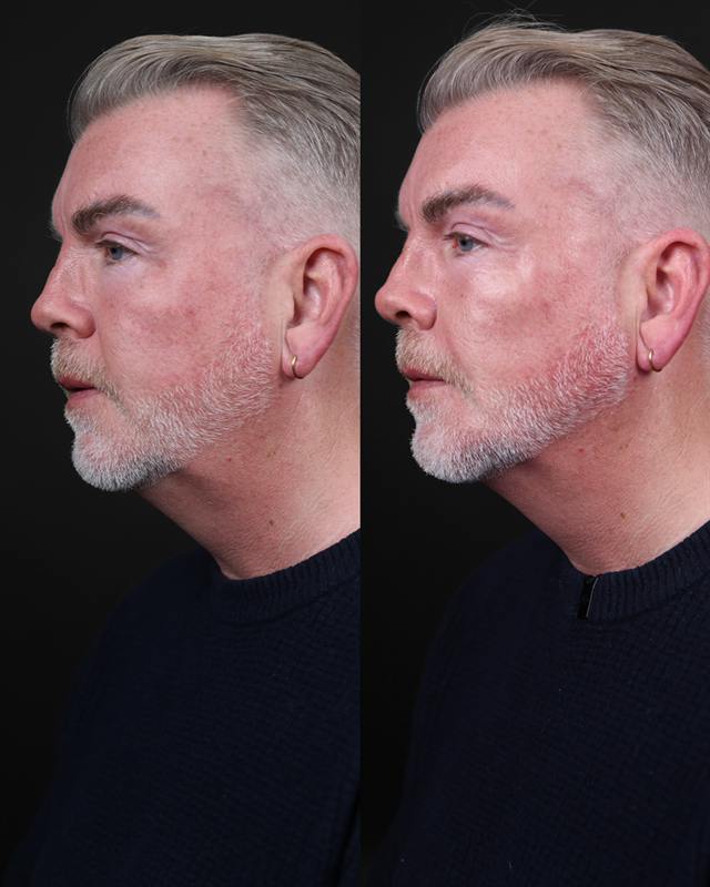Unretouched before and after result, the drBand Clinic