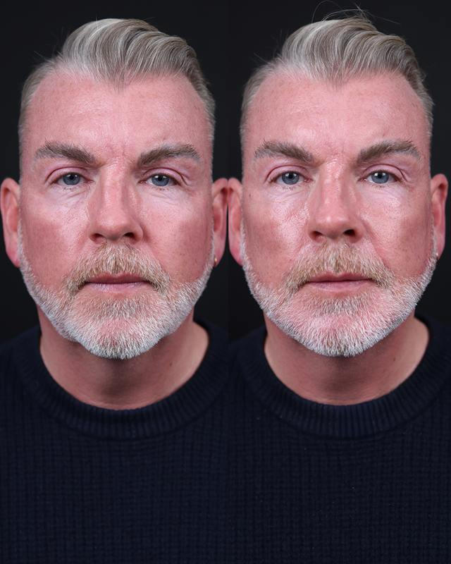 Unretouched before and after result, the drBand Clinic