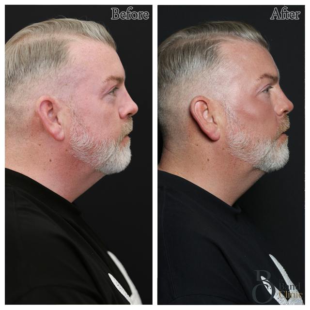 Unretouched before and after result, the drBand Clinic