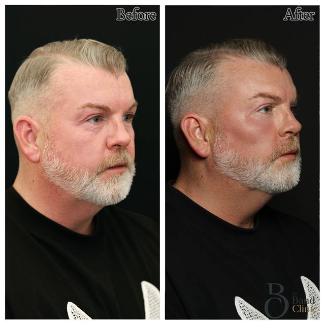 Unretouched before and after result, the drBand Clinic
