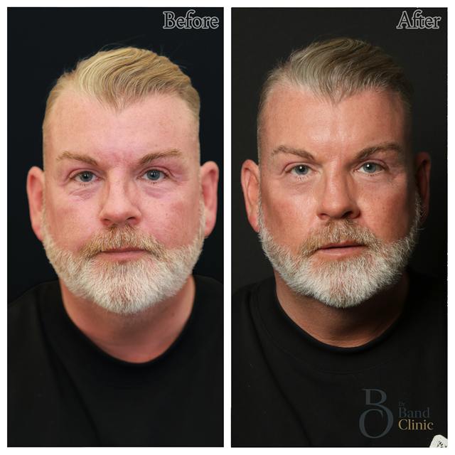 Unretouched before and after result, the drBand Clinic