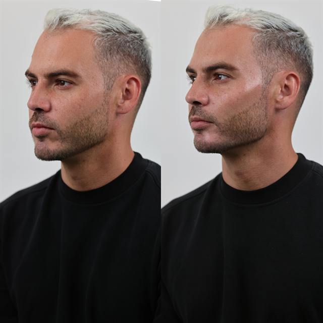 Unretouched before and after result, the drBand Clinic