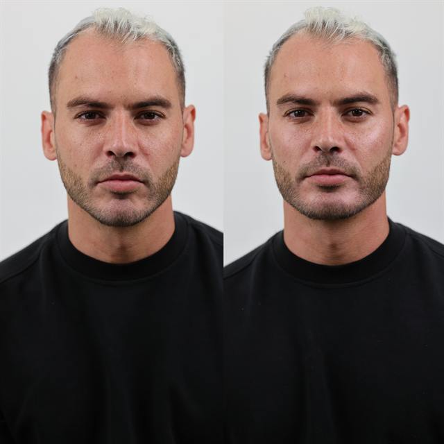 Unretouched before and after result, the drBand Clinic