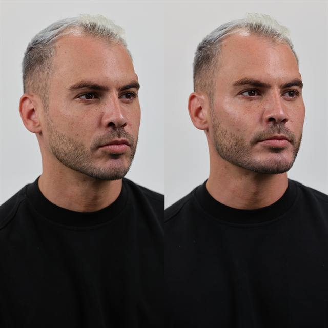 Unretouched before and after result, the drBand Clinic