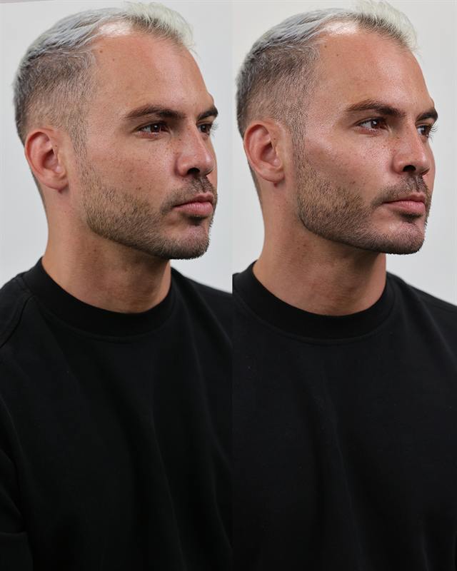 Unretouched before and after result, the drBand Clinic