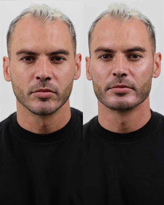 Unretouched before and after result, the drBand Clinic