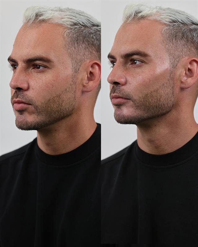 Unretouched before and after result, the drBand Clinic