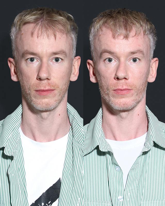 Unretouched before and after result, the drBand Clinic