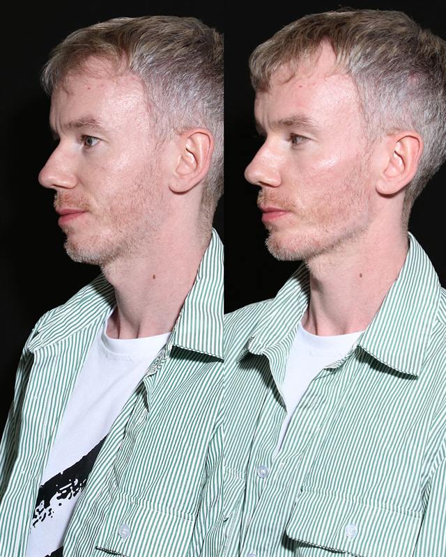 Unretouched before and after result, the drBand Clinic