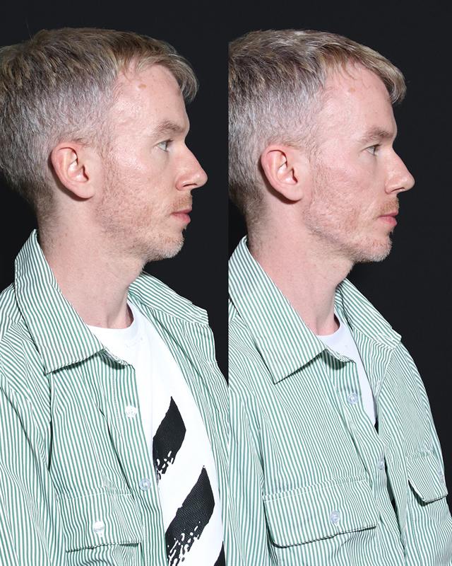 Unretouched before and after result, the drBand Clinic