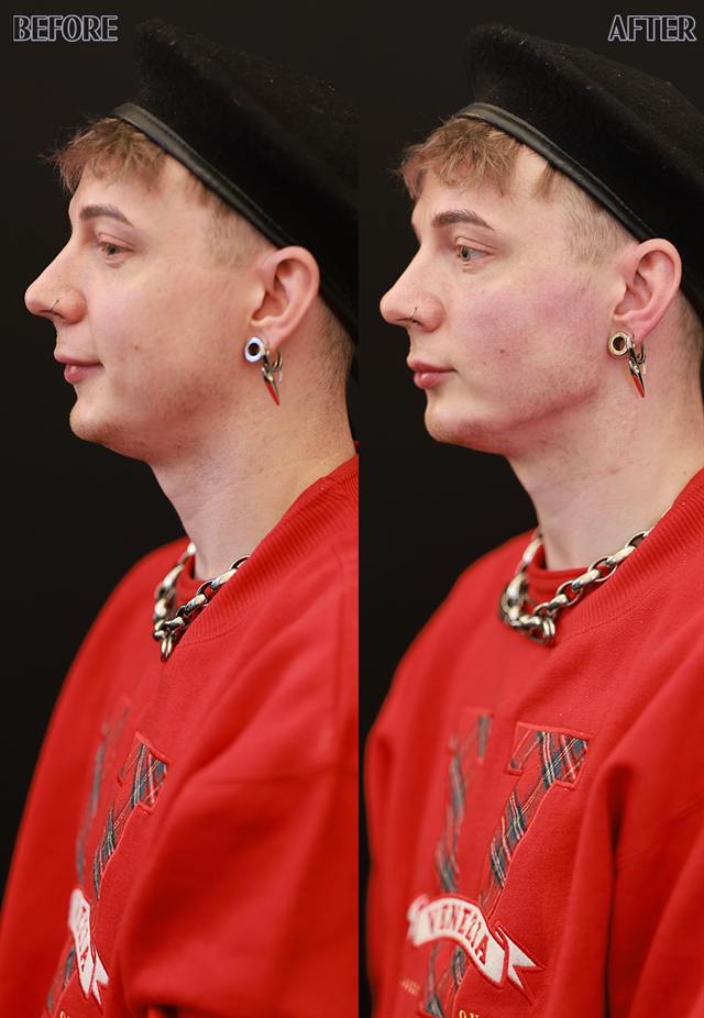 Unretouched before and after result, the drBand Clinic