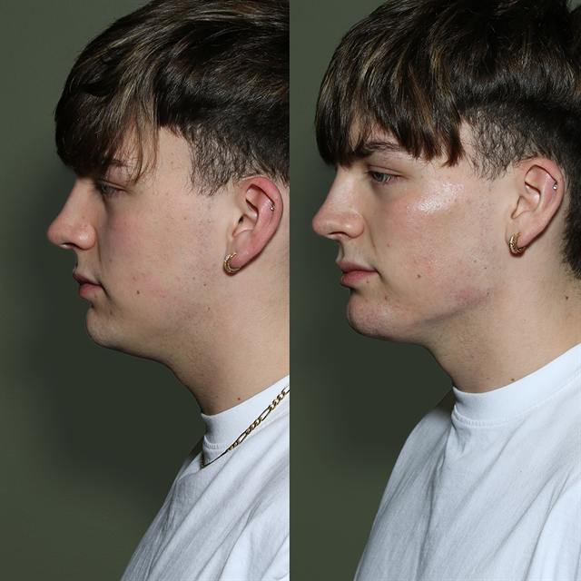 Unretouched before and after result, the drBand Clinic