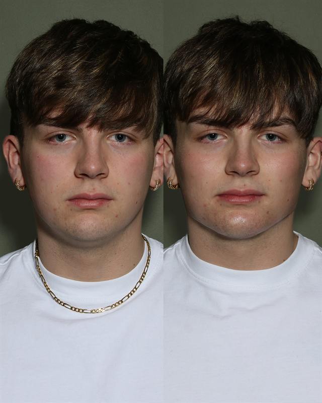 Unretouched before and after result, the drBand Clinic