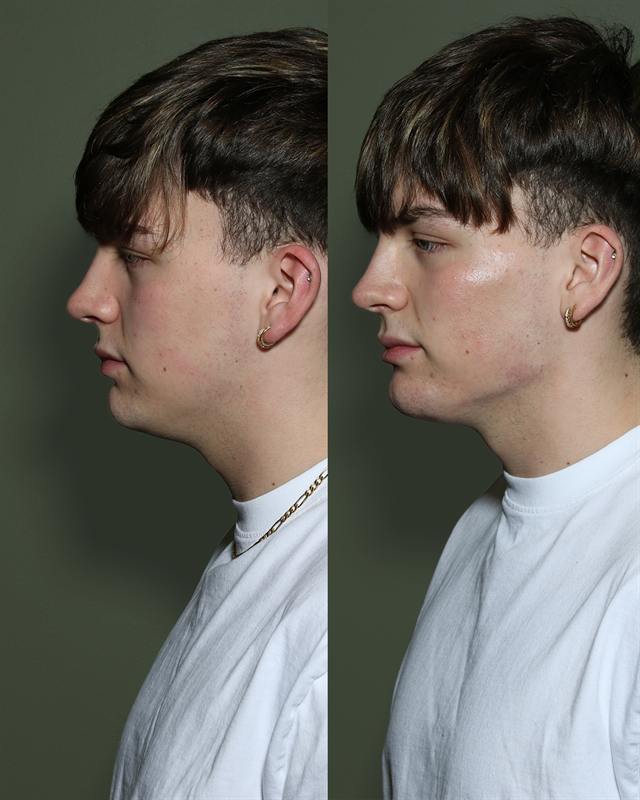 Unretouched before and after result, the drBand Clinic