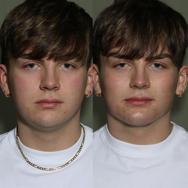 Unretouched before and after result, the drBand Clinic