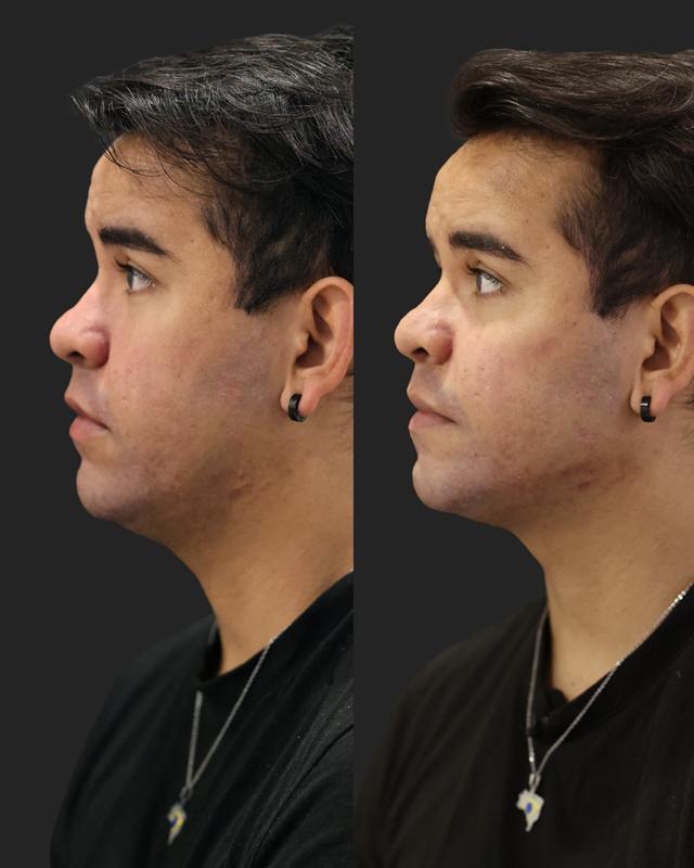 Unretouched before and after result, the drBand Clinic