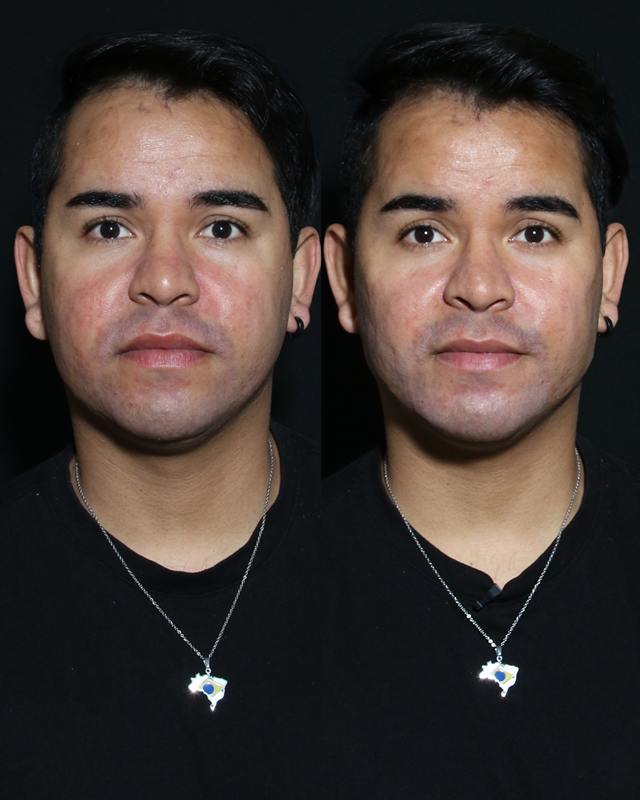 Unretouched before and after result, the drBand Clinic