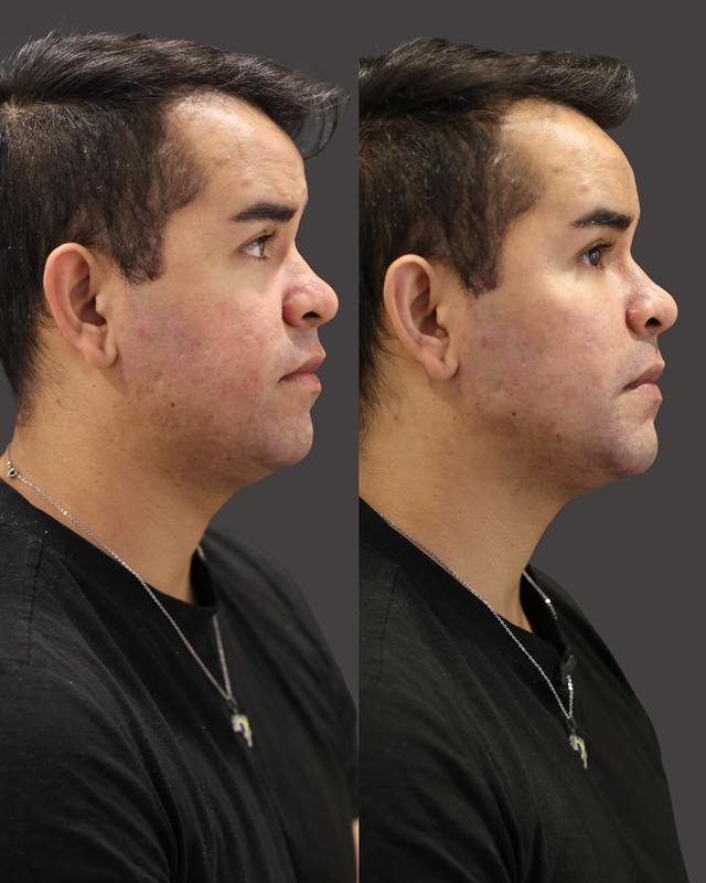 Unretouched before and after result, the drBand Clinic