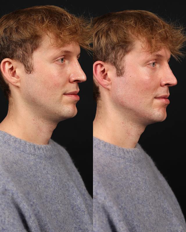 Unretouched before and after result, the drBand Clinic