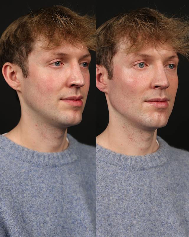 Unretouched before and after result, the drBand Clinic