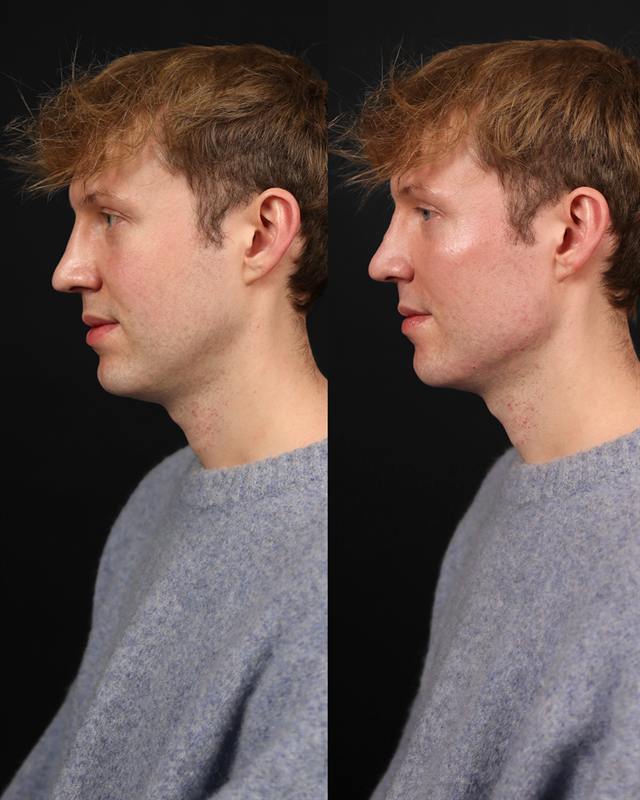 Unretouched before and after result, the drBand Clinic