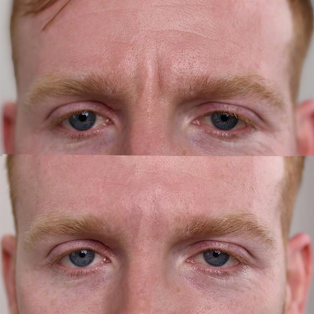 Unretouched before and after result, the drBand Clinic
