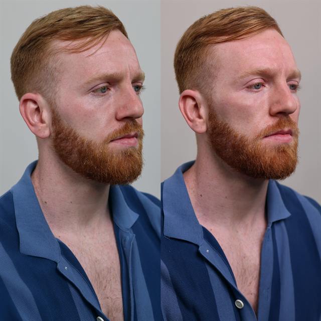Unretouched before and after result, the drBand Clinic