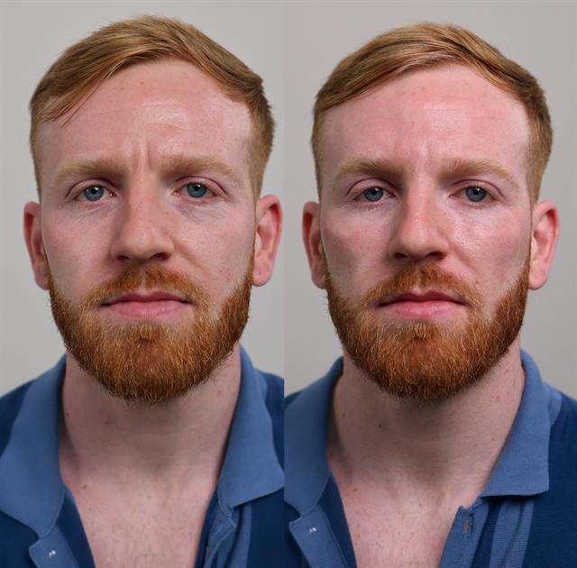Unretouched before and after result, the drBand Clinic