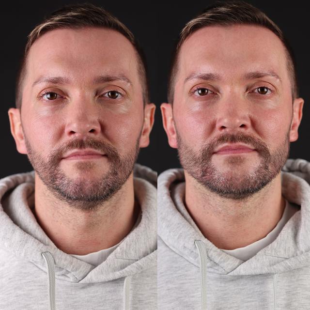 Unretouched before and after result, the drBand Clinic