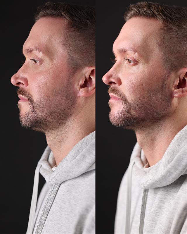 Unretouched before and after result, the drBand Clinic