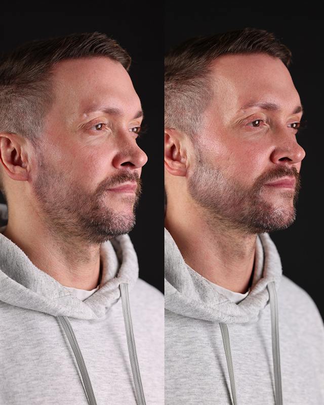 Unretouched before and after result, the drBand Clinic