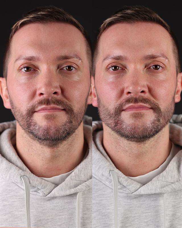Unretouched before and after result, the drBand Clinic