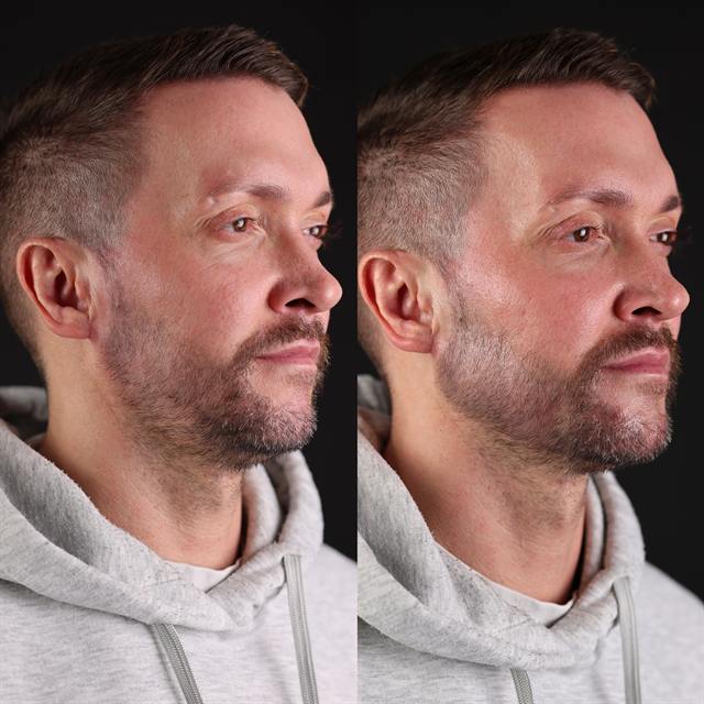 Unretouched before and after result, the drBand Clinic