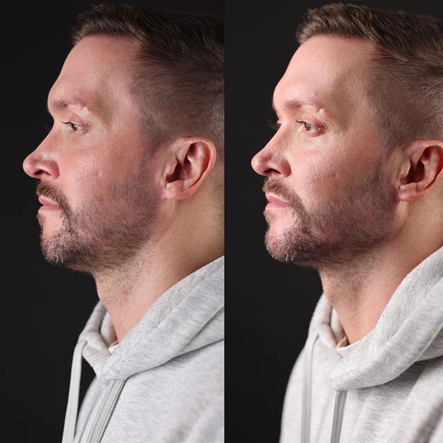 Unretouched before and after result, the drBand Clinic