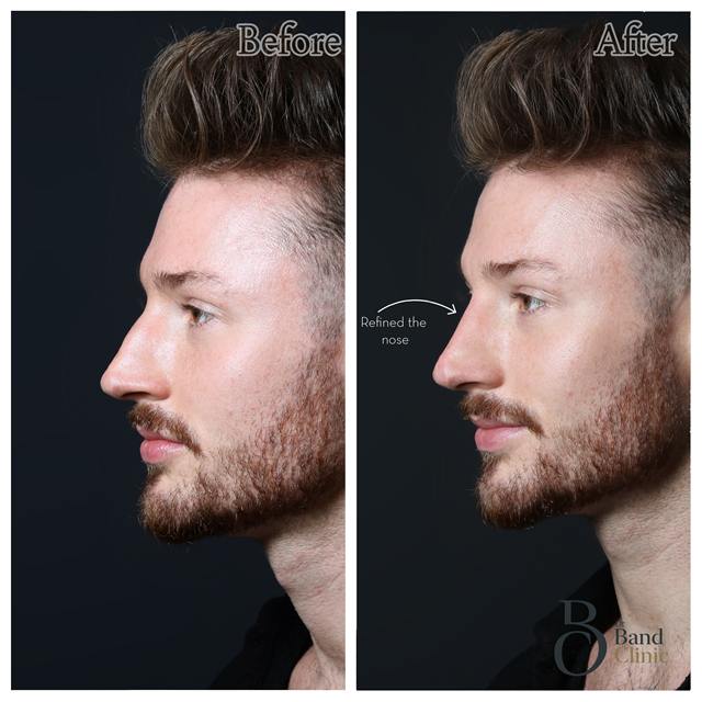 Unretouched before and after result, the drBand Clinic