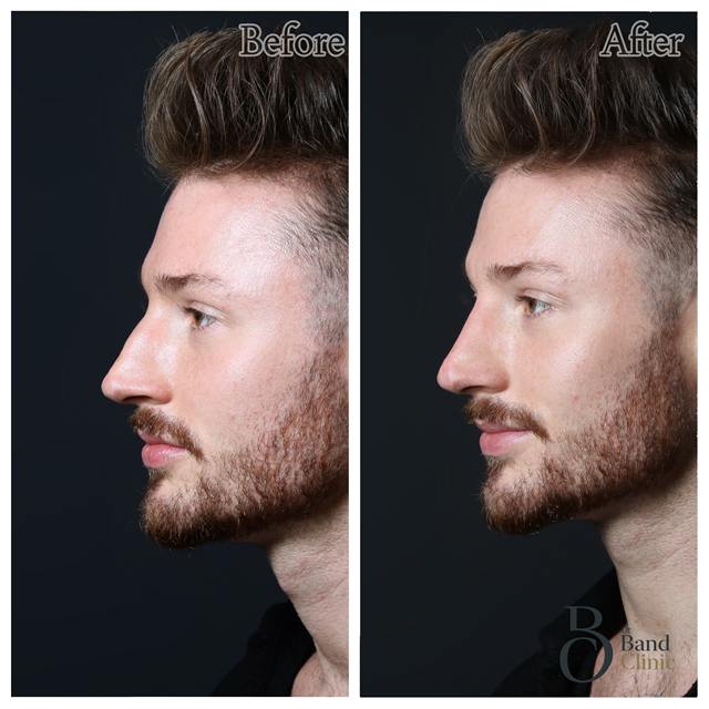 Unretouched before and after result, the drBand Clinic
