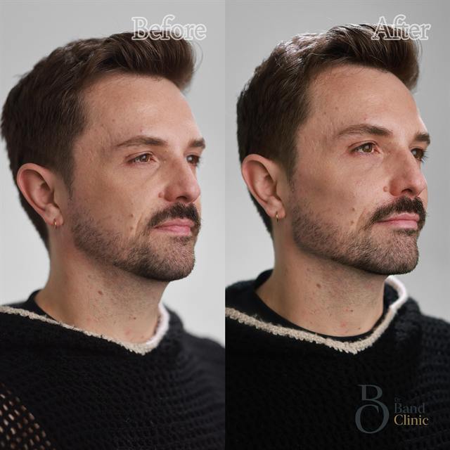 Unretouched before and after result, the drBand Clinic