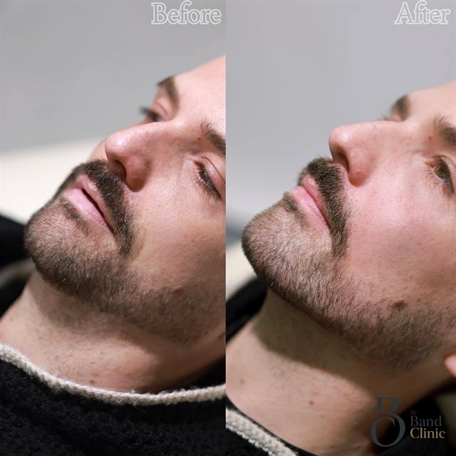 Unretouched before and after result, the drBand Clinic
