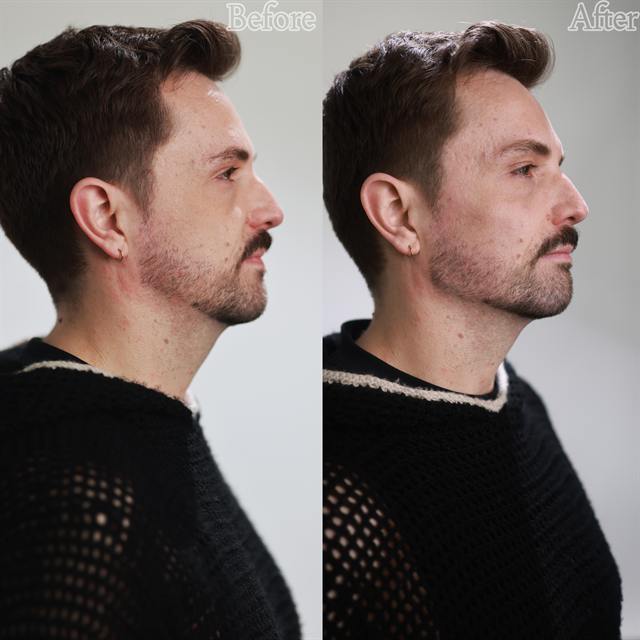 Unretouched before and after result, the drBand Clinic