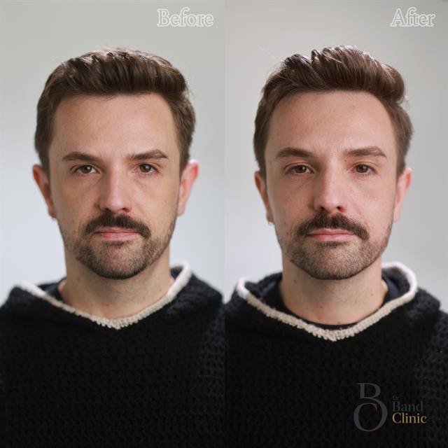 Unretouched before and after result, the drBand Clinic