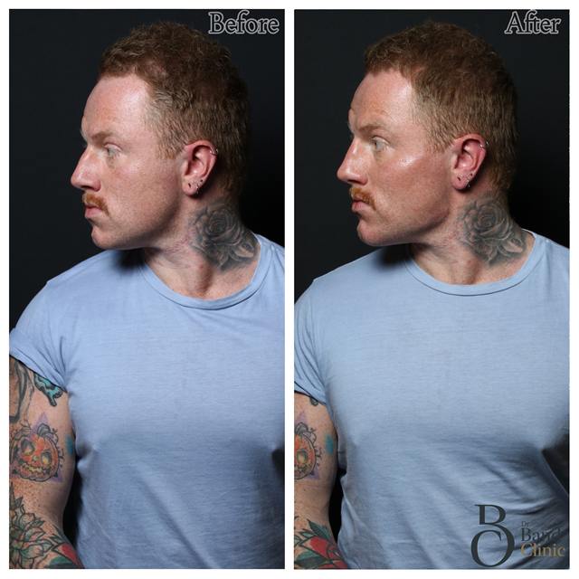 Unretouched before and after result, the drBand Clinic